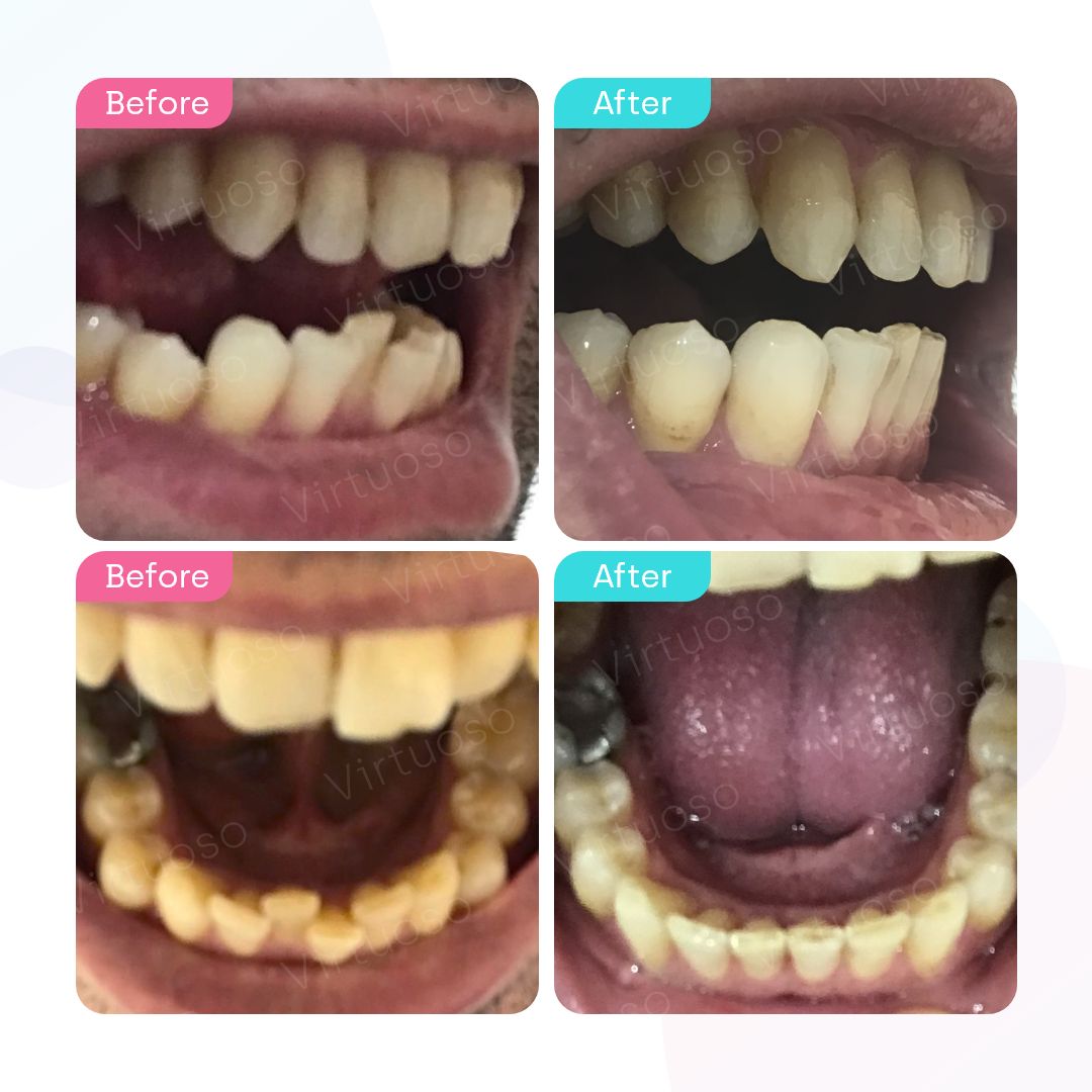 Before & After photos of a patient with crooked teeth