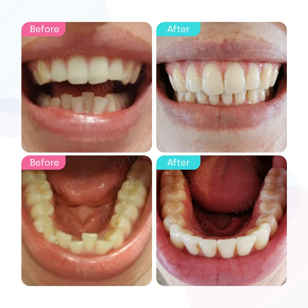 Before & After photos of a patient with crooked teeth