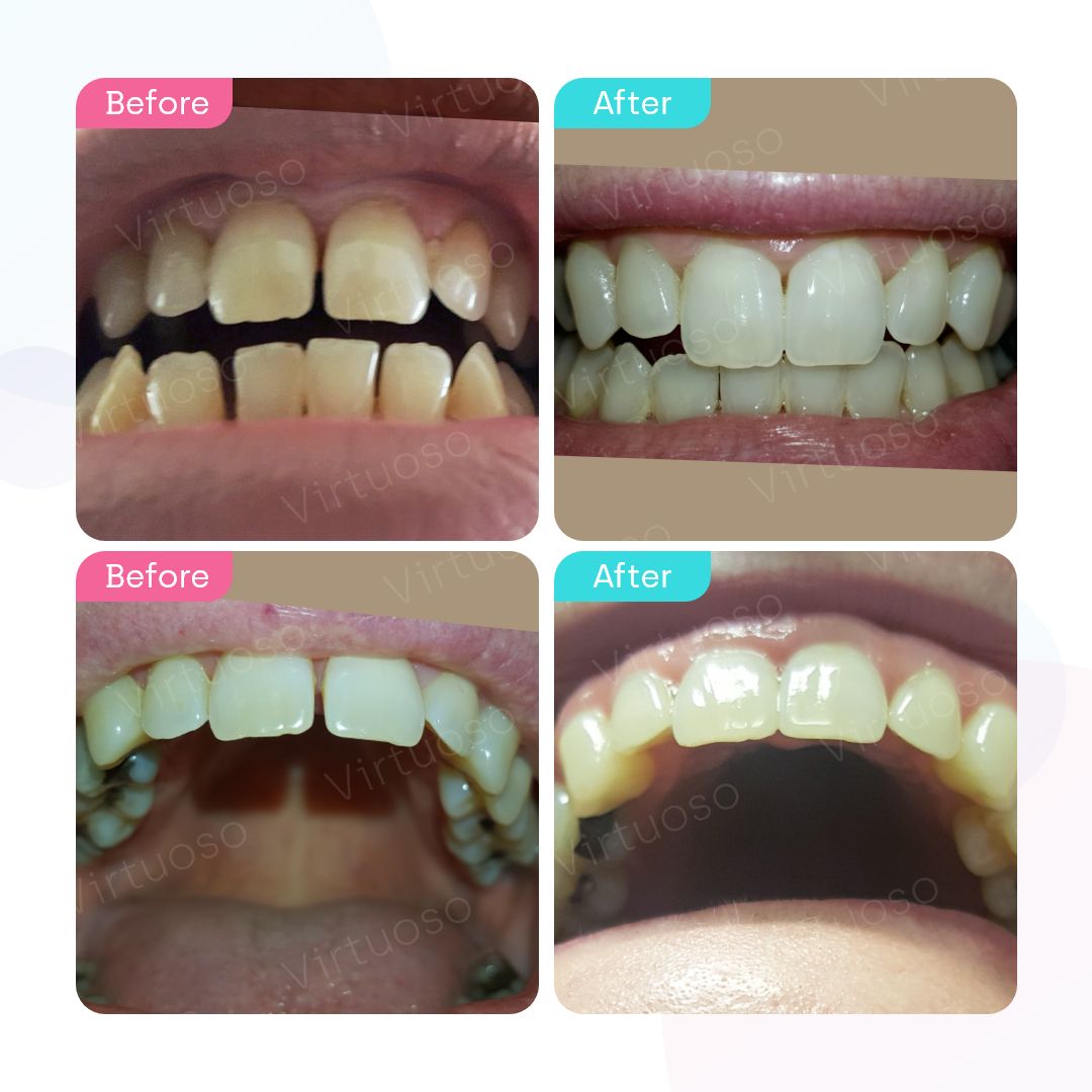 Before & After photos of a patient with gappy teeth