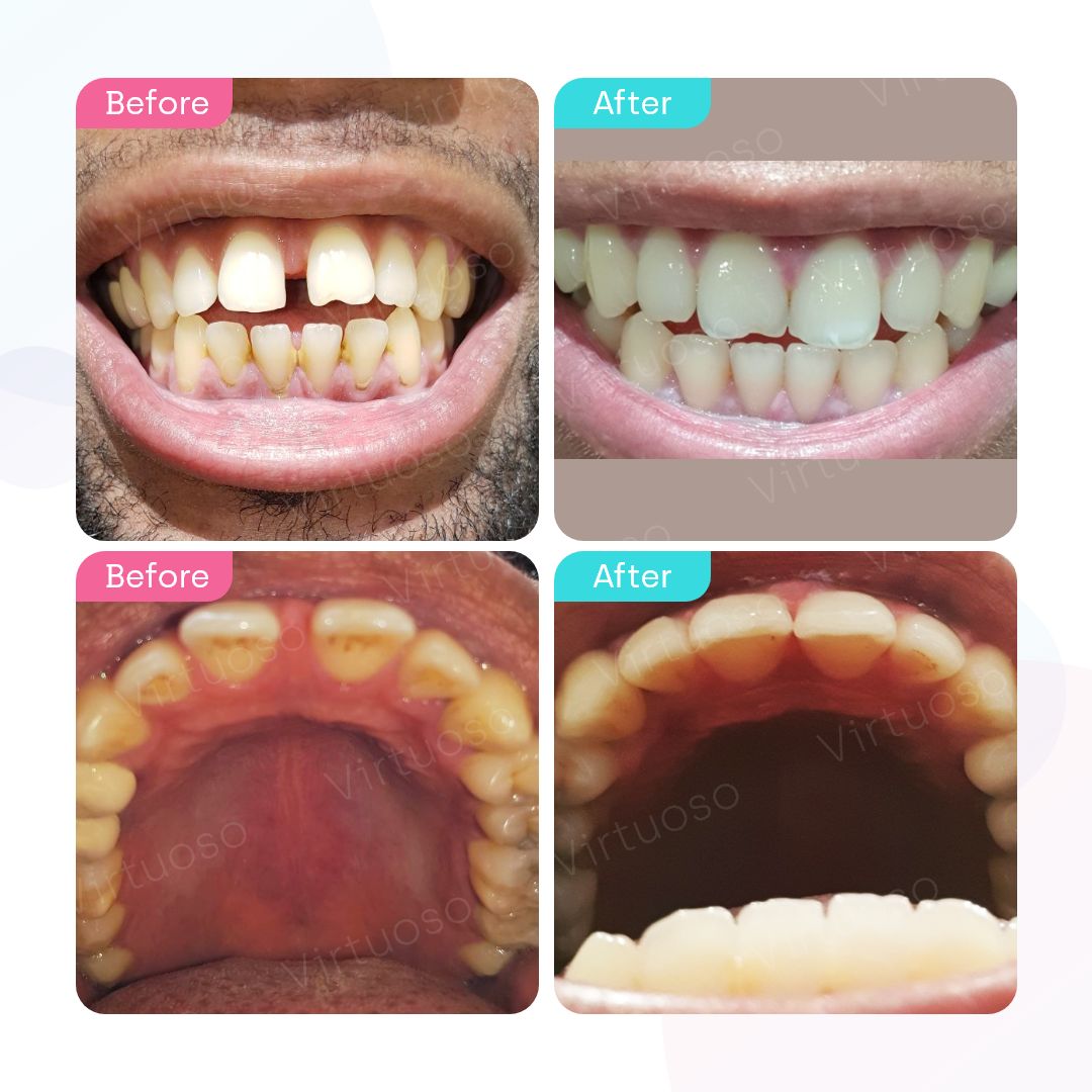 Before & After photos of a patient with gappy teeth