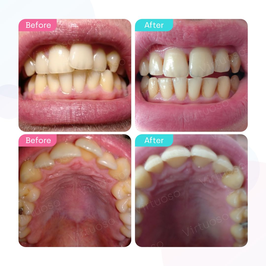 Before & After photos of a patient with overlapping teeth