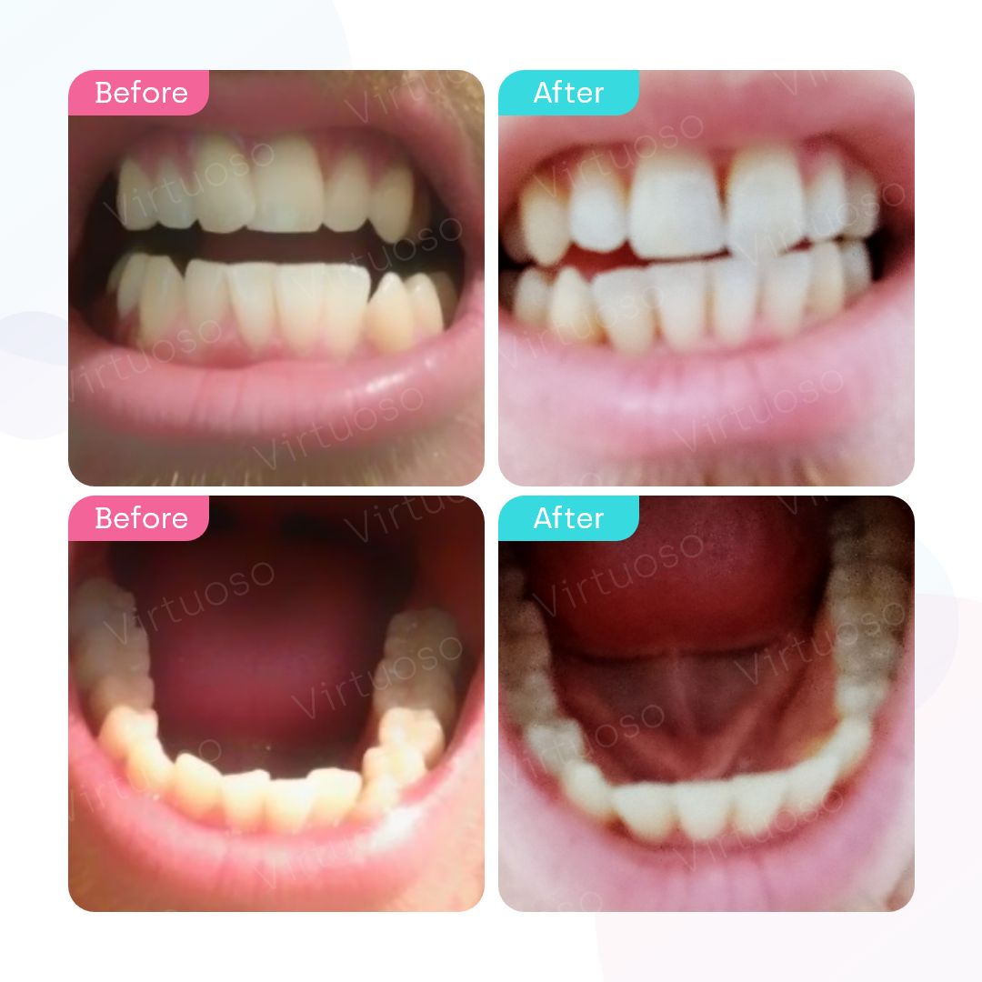 Before & After photos of a patient with overlapping teeth
