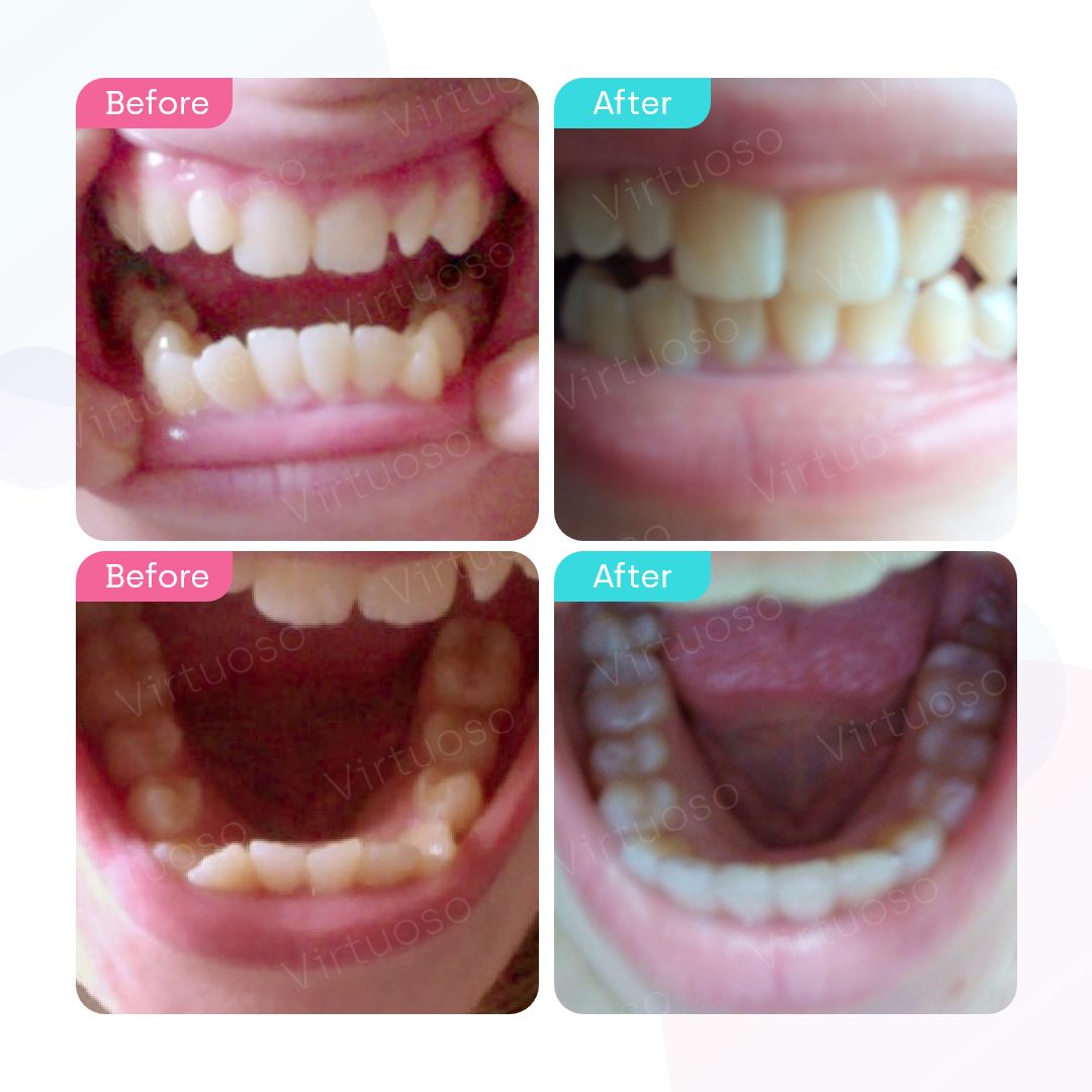 Before & After photos of a patient with protrusion teeth