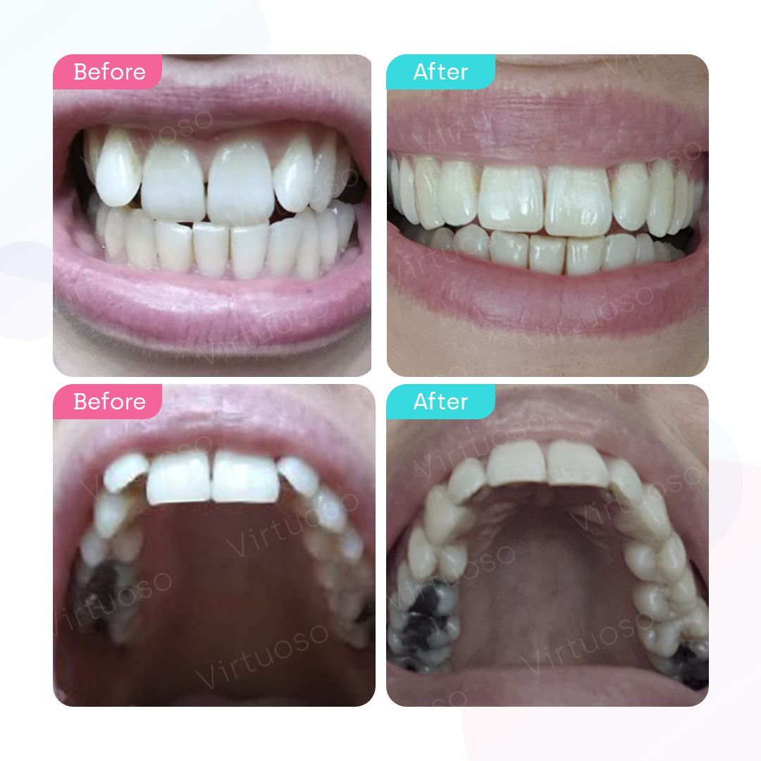 Before & After photos of a patient with protrusion teeth